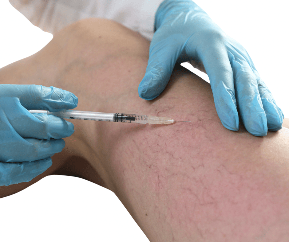 sclerotherapy